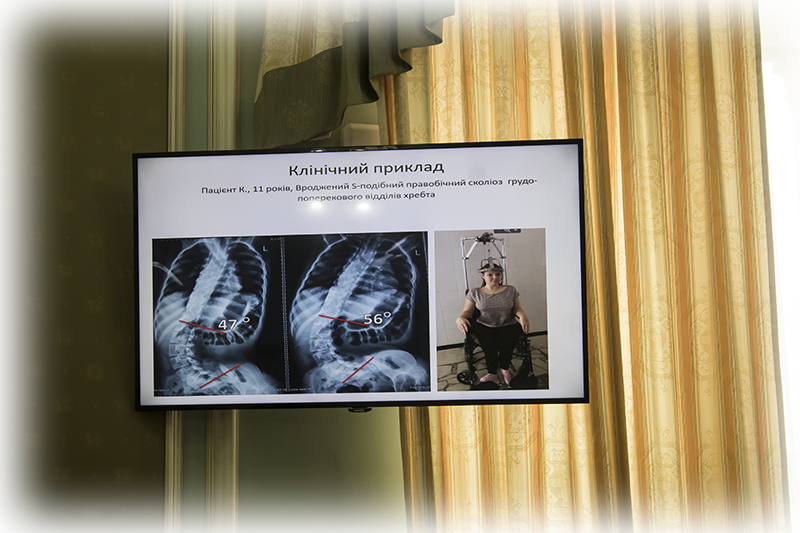 Круглий стіл "Spina Bifida-не вирок"